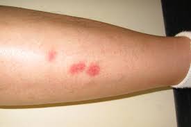 Image result for cartoon flea red bumps on people