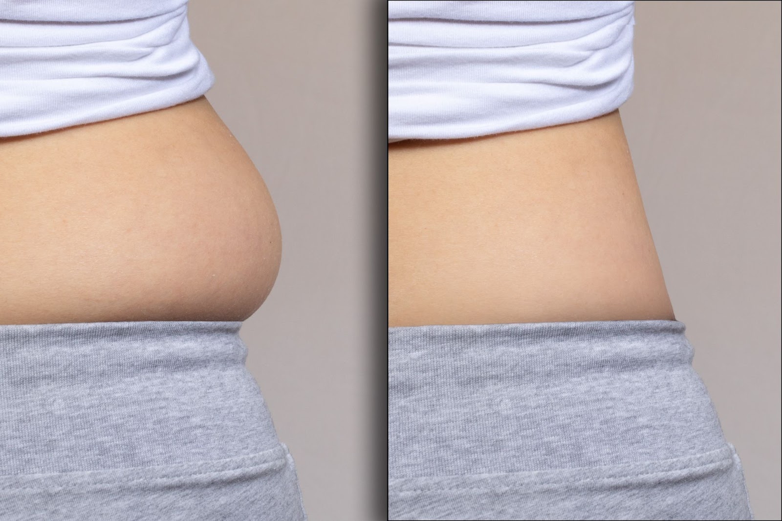 Patient 3 tummy tuck before and after 