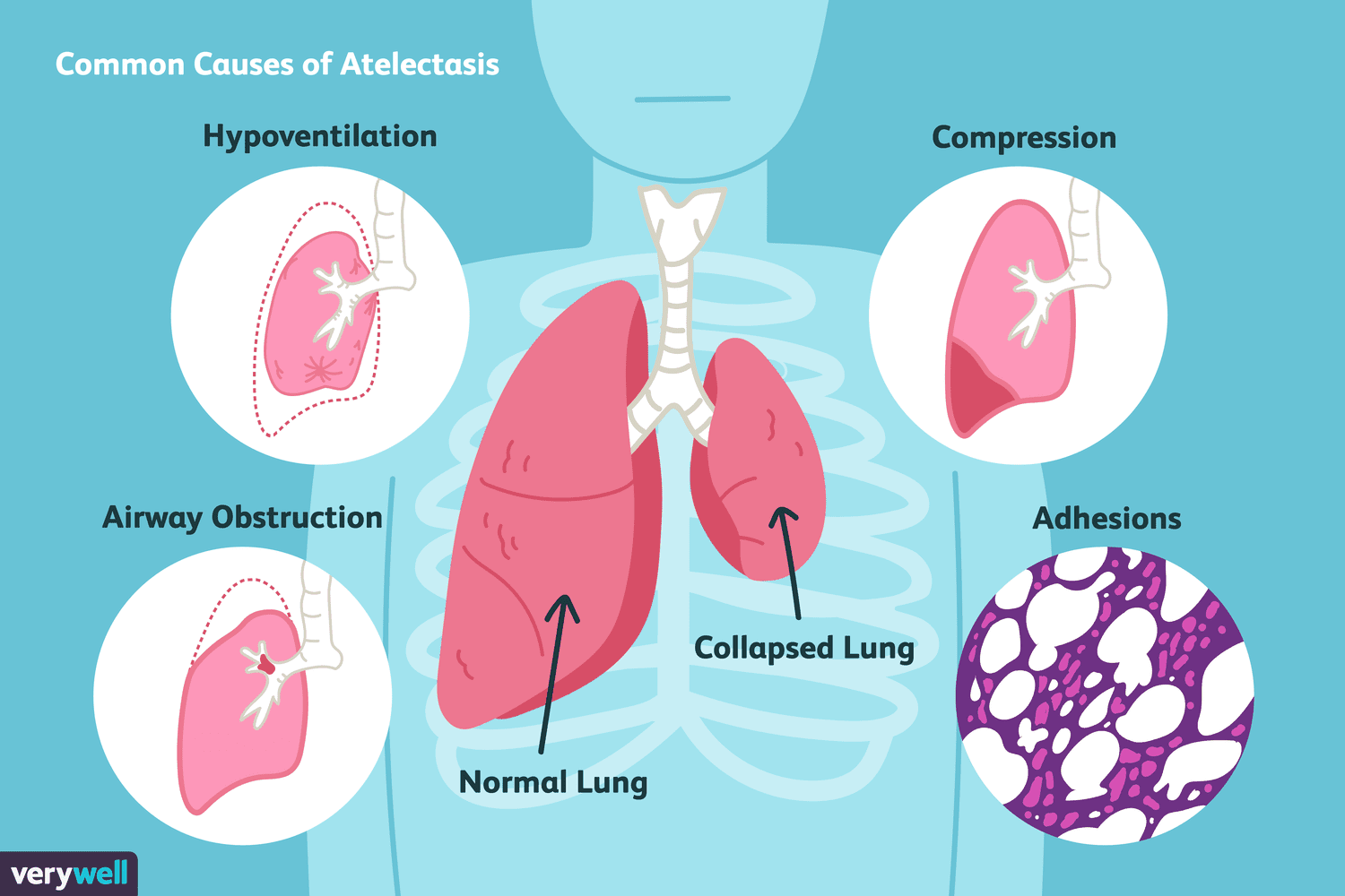 Bibasilar Atelectasis: Symptoms, Treatment, and More
