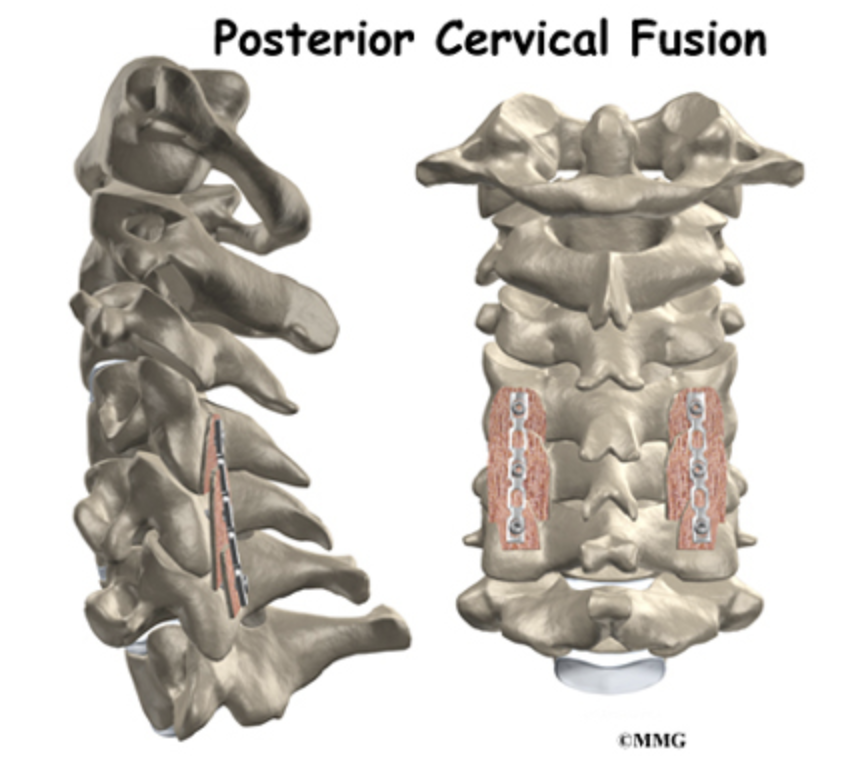 posterior-cervical-fusion
