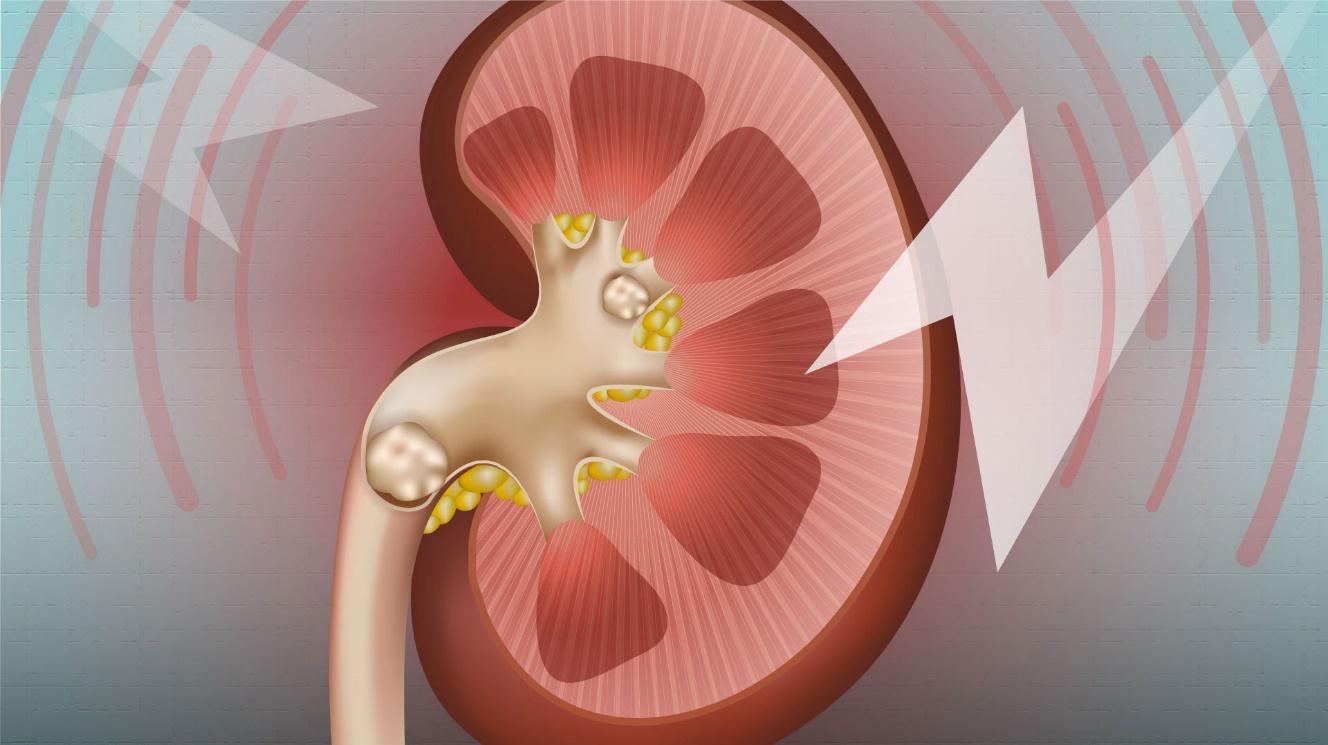 Kidney stones - a marker of overall kidney health - News | UAB