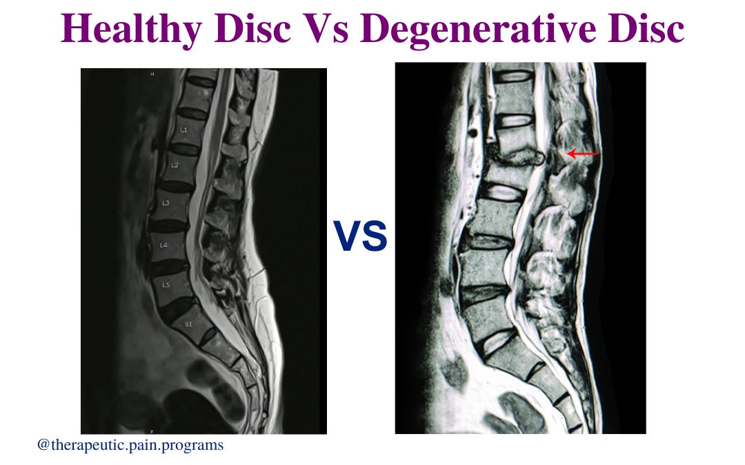 Difference between Healthy Disc and Degenerative Disc 