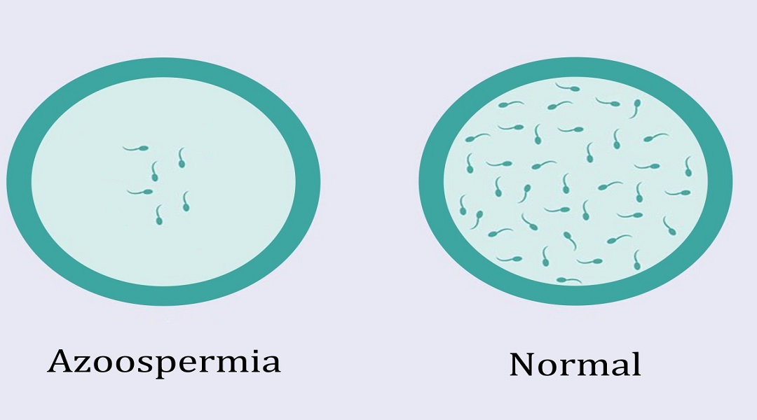 What is Azoospermia?