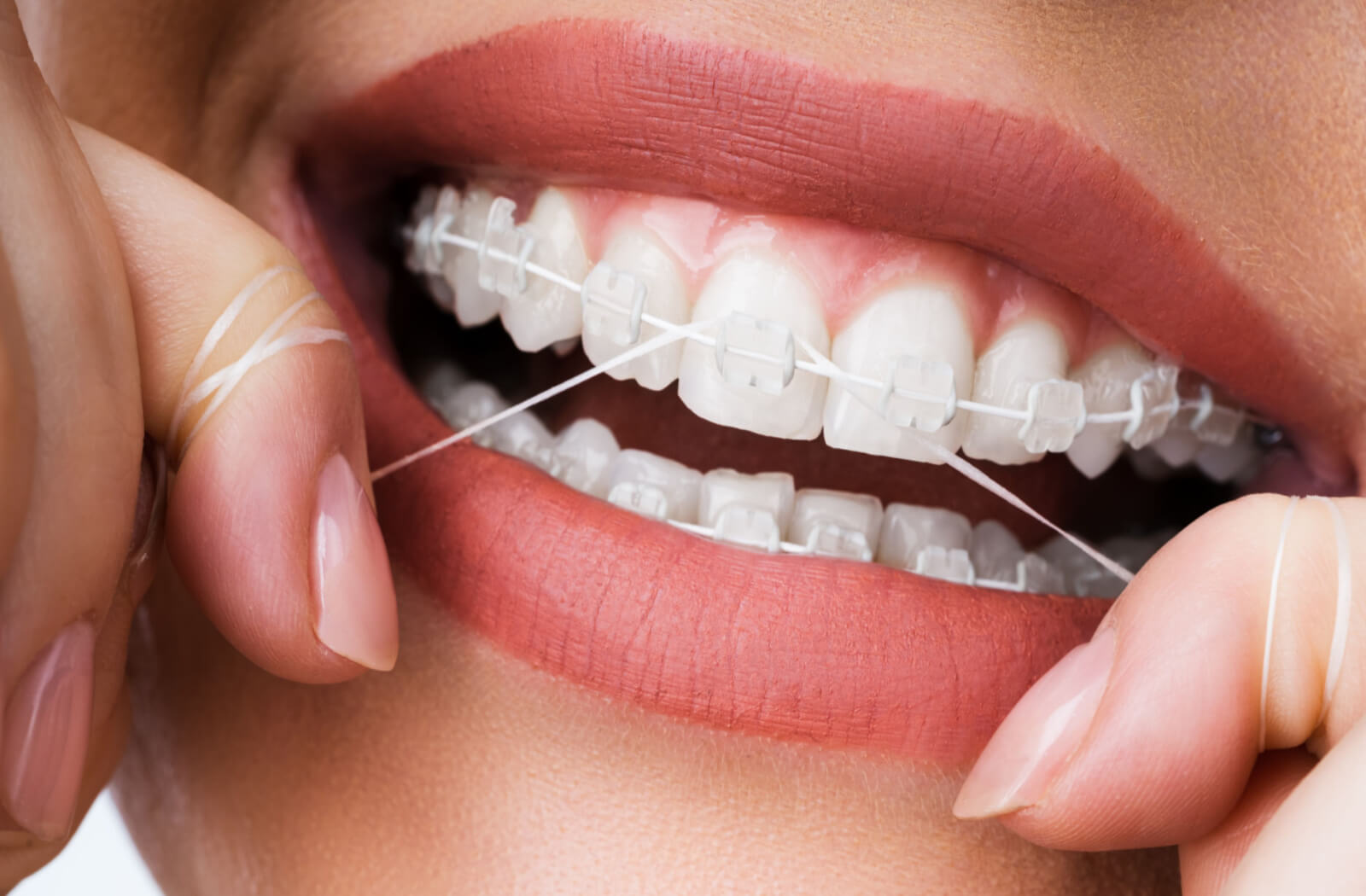 close up image of a woman flossing around her braces