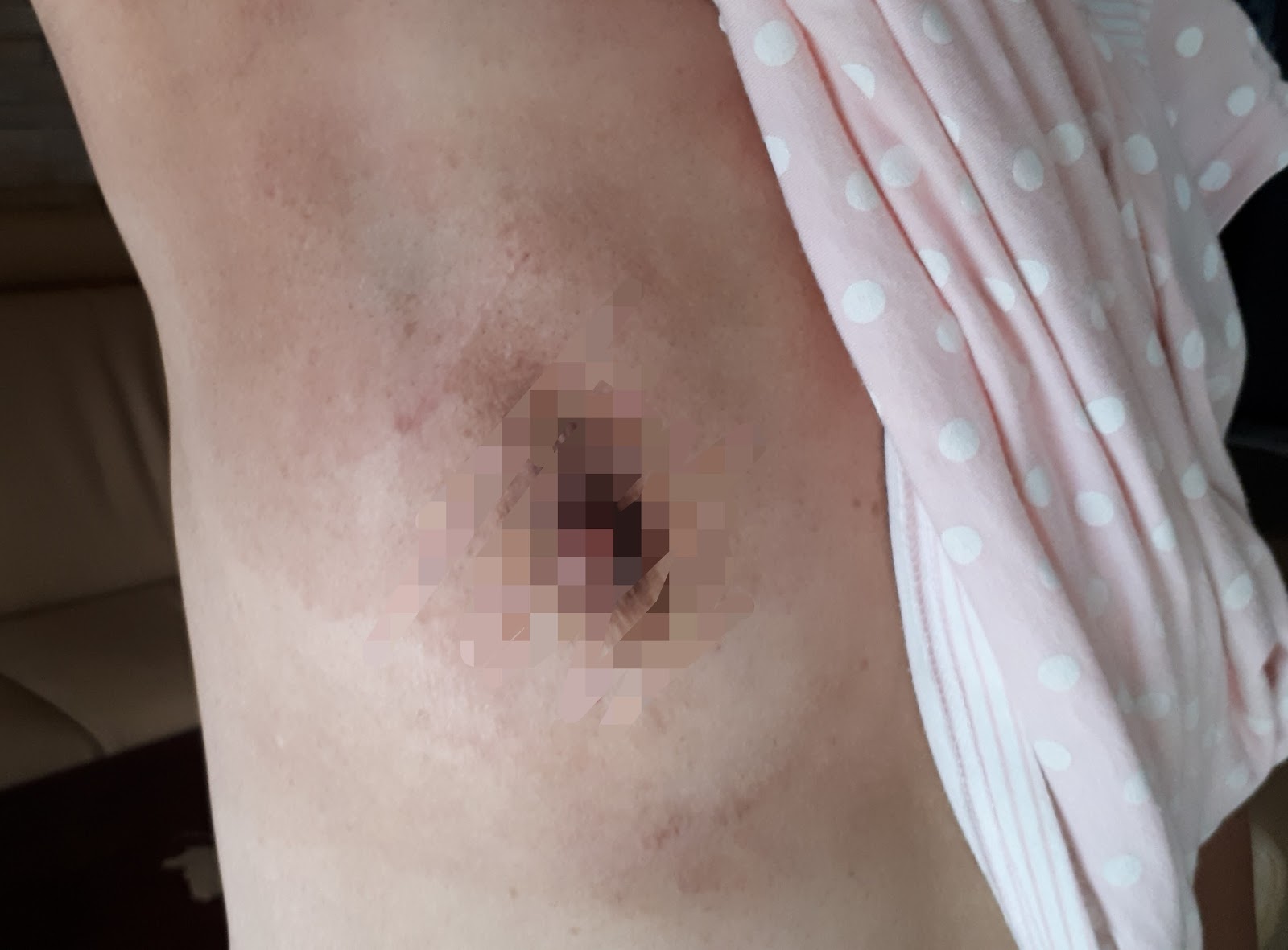 乳癌局切 放療比全切危險嗎 乳癌沒有全切會危險嗎 下集 蘇菲向前行 痞客邦