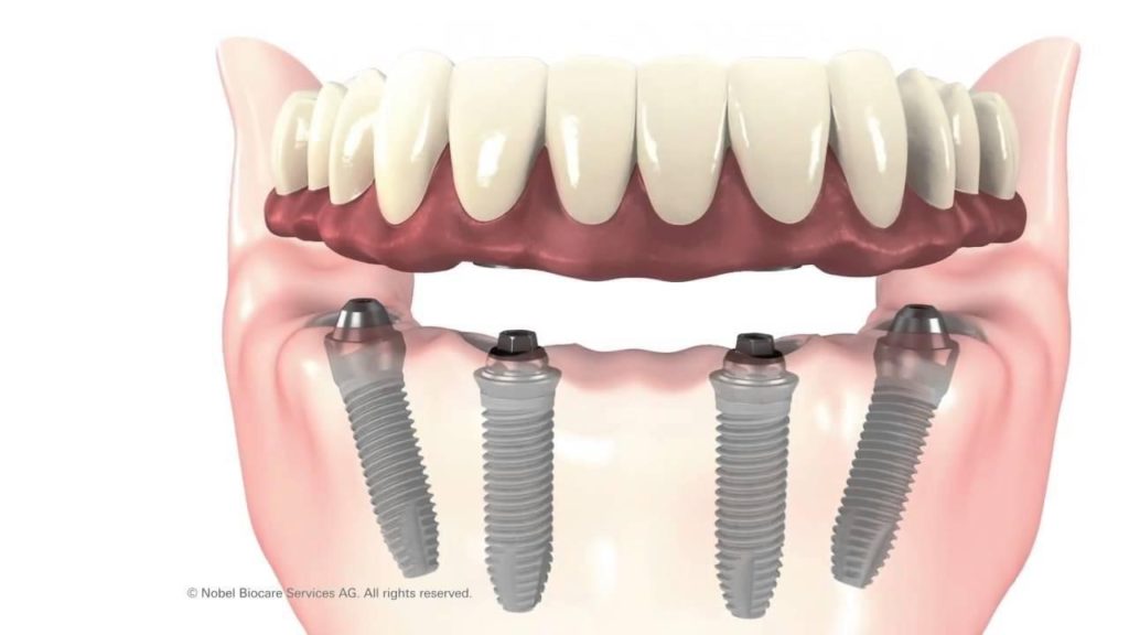 cay ghep implant all on 4 cho truong hop mat rang toan ham