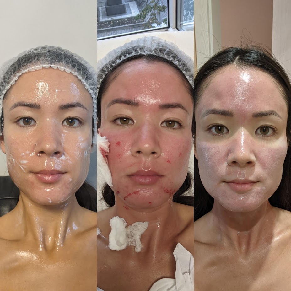 CO2 Fraxel Laser Review - Did My Old Atrophic Acne Scars Improve? -  MICHXMASH