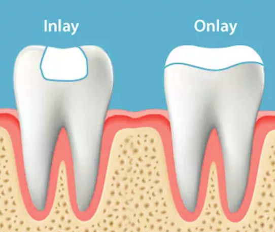 Exemplu incrustatii dentare
