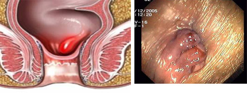 Bệnh trĩ nội độ 1