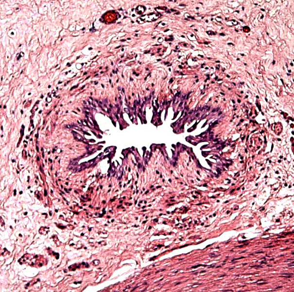 Allantoic duct of second placenta's umbilical cord