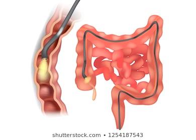 Káº¿t quáº£ hÃ¬nh áº£nh cho endoscopy colon