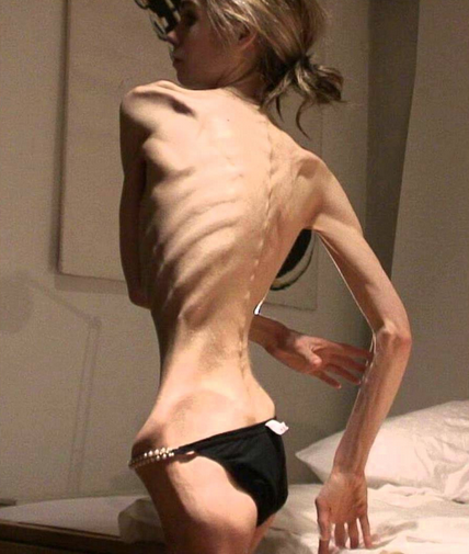 AnorexicWoman.png