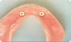 Implant dentaire 2