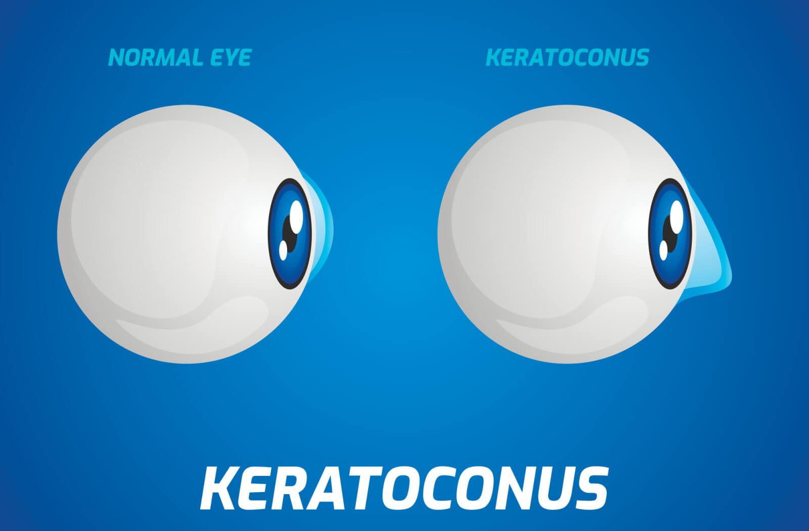 a graphic of two eyes from the side. one is a normal eye, and the other shows the cornea bulging, as that eye has keratoconus