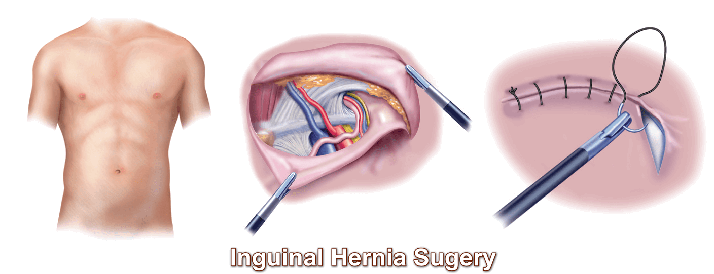 Hernia Surgery Specialist Downtown San Antonio Tx Rolando