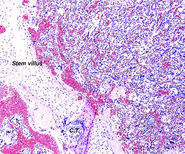 At left is one of the long stem connecting stalks with island of cytotrophoblast or extravillous trophoblast. At right is the diffuse villous tissue