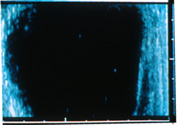 Ultrasound photo of a large follicle with multiple echogenic particles within the follicular fluid. The echogenic spots may represent blood or rafts of granulosa cells floating within the follicular lumen.