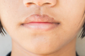dry lips image