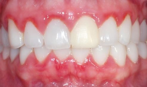 Gum-disease-gingivitis