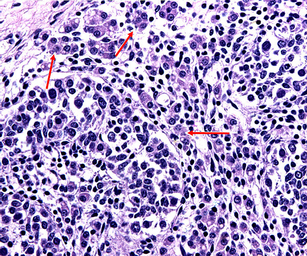 Fetal testis with interstitial cells at red arrows.