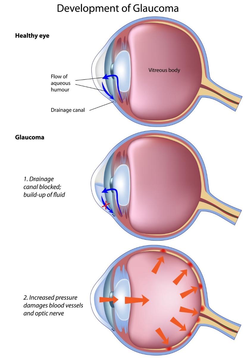 Going Blind with Glaucoma | Pennachio Eye | Clermont - Pennachio Eye