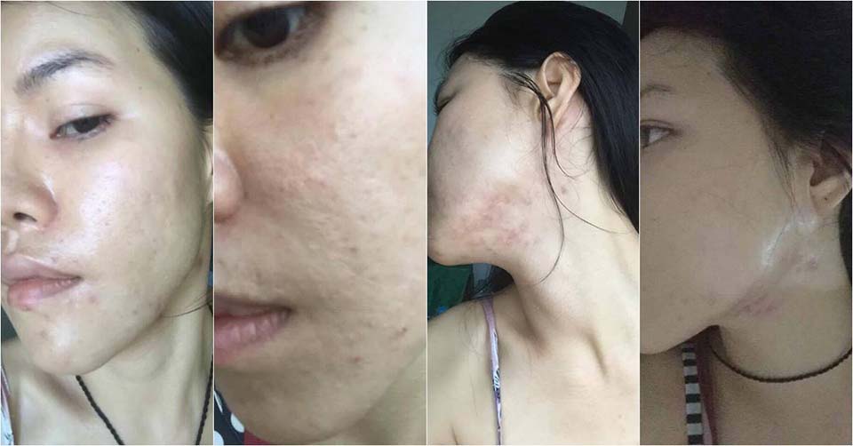 Berof Skincare Acne treatment Lahore