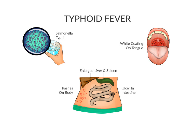 Causes of Typhoid