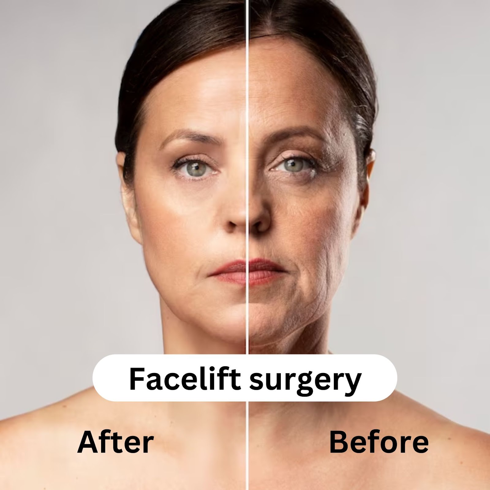 facelift before/after results