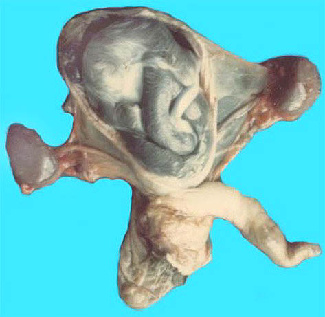 Uterus with bladder and anterior wall removed to expose the fetal position