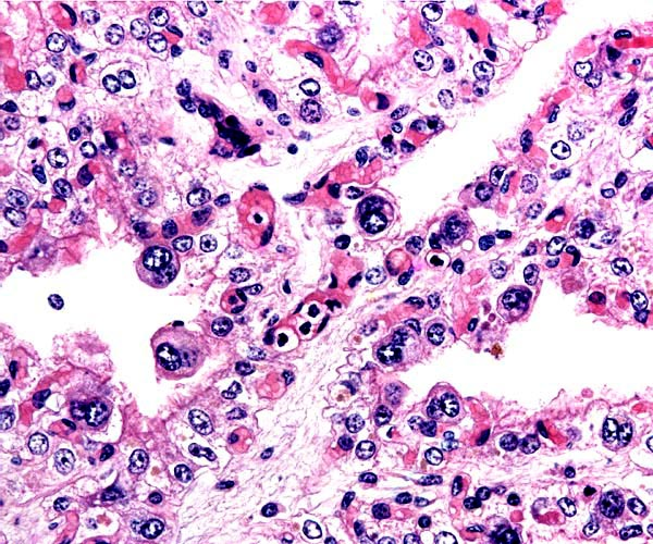 Higher magnification of villi with at least three large, typical binucleate cells.