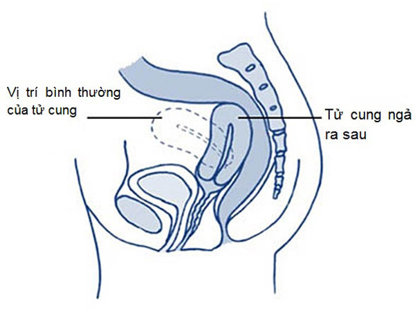 Tại sao tôi bị đau mông trong kì rớt dâu? - Ảnh 2.