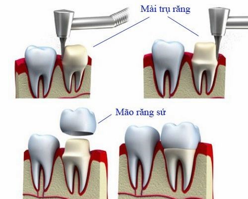 Trồng răng sứ có sử dụng vĩnh viễn được không?