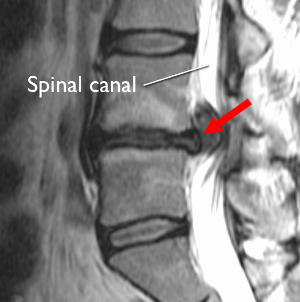 Is it worth getting an MRI for a herniated disc?