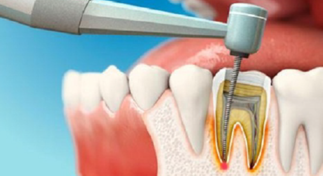 Lấy tủy răng có đau không? gây ảnh hưởng gì 3