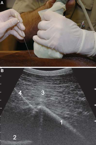 Ultrasonography-guided injection of the lumbosacral junction.