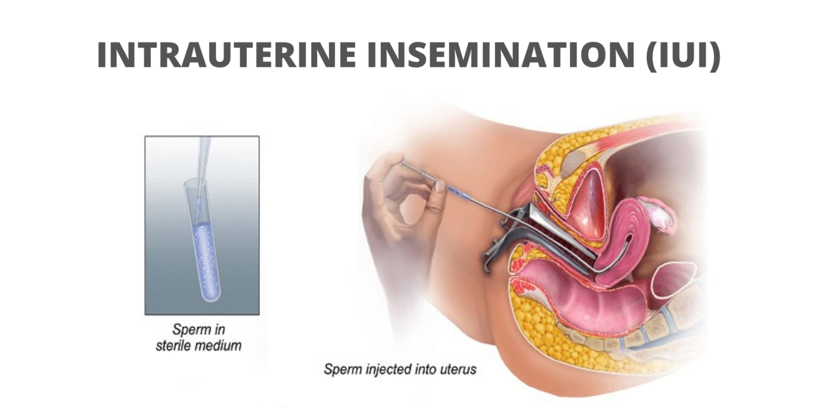Intrauterine Insemination (IUI) in the Philippines