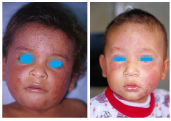 Pacientes com dermatite atópica na fase infantil