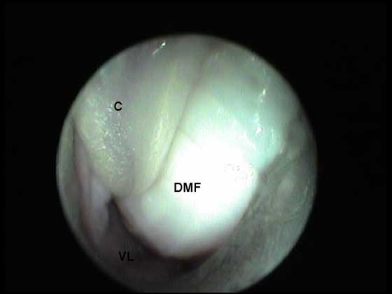Paracervix con el gran pliegue dorso-medial y un creciente lúmen vaginal (LV)