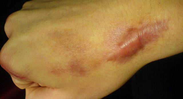 蟹足腫就是患者傷口在癒合的時候，如果當時傷口有達到真皮層(Dermis)以下，就會產生疤痕組織，而「蟹足腫」意指在傷口修復時產生了過多的疤痕組織。