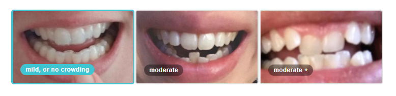 Review of the SmileDirectClub Aligners: Do They Work? 9