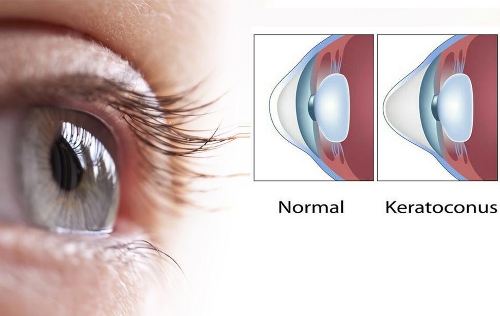 кератоконус и нормальный глаз