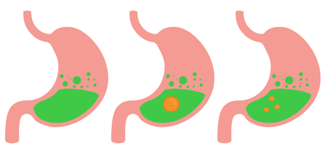 Imagem mostrando 3 estômagos:

1. apenas com o suco gástrico;
2. com suco gástrico + bolo alimentar;
3. com suco gástrico + bolo alimentar em menor quantidade