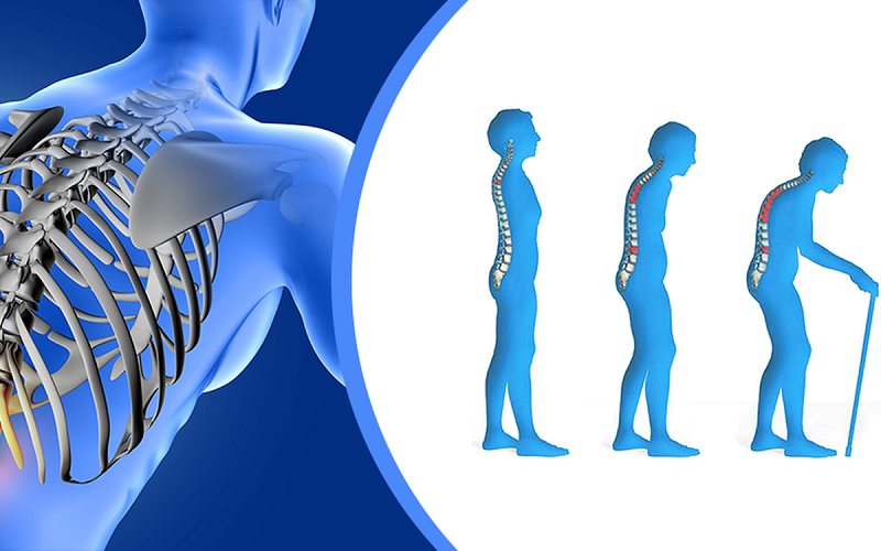 Loãng xương có thể do tuổi tác hoặc một số nguyên nhân khác về nội tiết tố và xương