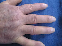 What is scleroderma