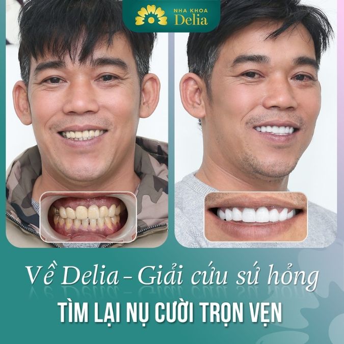 Giải pháp khắc phục răng sứ bị hỏng hiệu quả