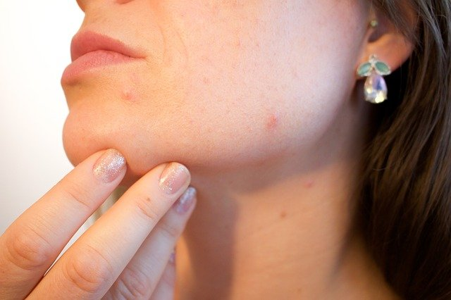 beauty myths facial acne on woman