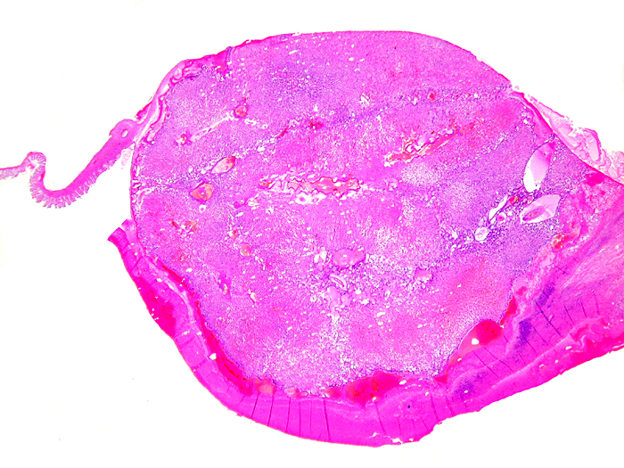 Marginal aspect with insertion of membranes and subplacenta at bottom right.