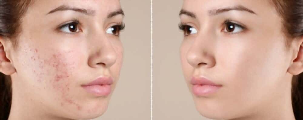 Antibiotics for acne before and after 