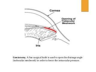 Congenital glaucoma