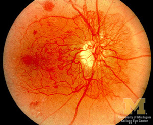 Early proliferative retinopathy